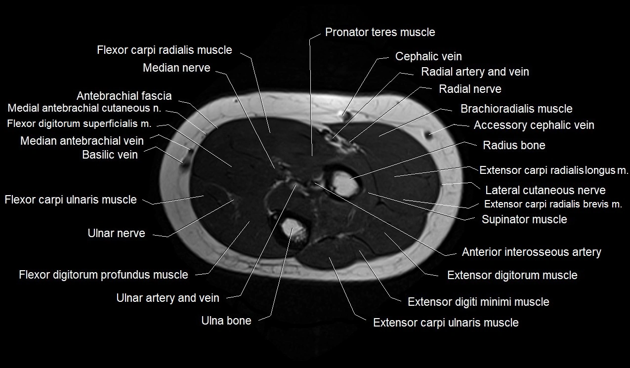 MRI 3T forearm axial cross sectional anatomy image 15.webp